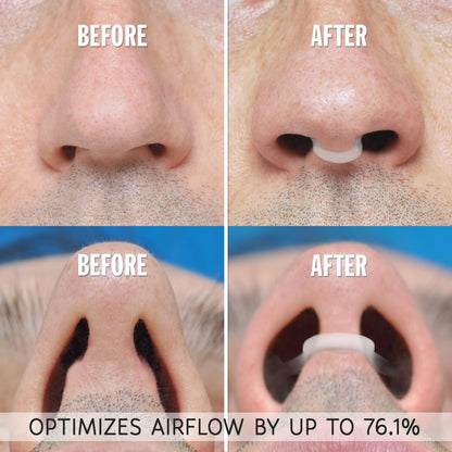 Before and after comparison of a nose with a device inserted, optimizing airflow.
